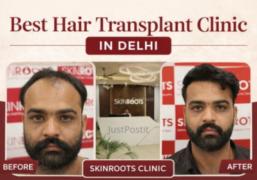 Best Hair Transplant in Delhi