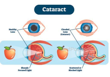 Cataract Eye Treatment Cost in Bangalore