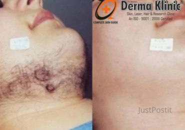 Laser hair Removal In Lucknow