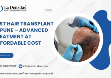 Best Hair Transplant in Pune