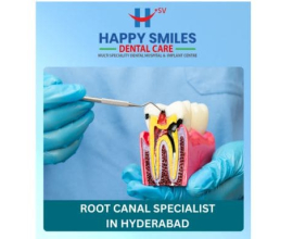 Painless Root Canal Specialist in Hyderabad