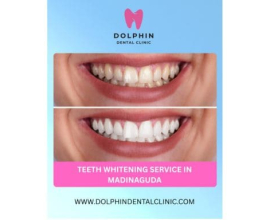 Professional Teeth Whitening Service in Madinaguda