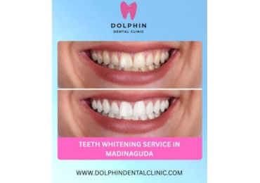Professional Teeth Whitening Service in Madinaguda
